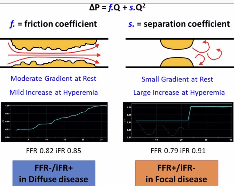 CircIntv's tweet image. Traveling to #SCAI2019 Here is May’s reading material from circinterventions.ahajournal.org during travels ➡️Rotational Atherectomy, Adverse Outcomes after Mitral Valve Repair, IFR/iFR discordance, #FFR guided #SVG implantation @HeartNews @American_Heart @CircAHA @CircOutcomes @SCAI