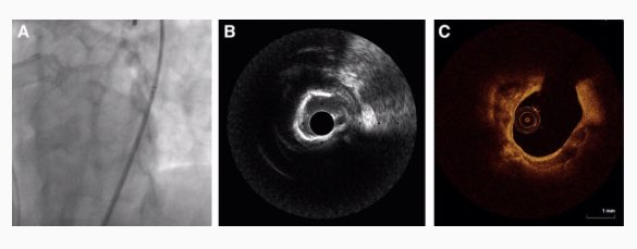 CircIntv's tweet image. Traveling to #SCAI2019 Here is May’s reading material from circinterventions.ahajournal.org during travels ➡️Rotational Atherectomy, Adverse Outcomes after Mitral Valve Repair, IFR/iFR discordance, #FFR guided #SVG implantation @HeartNews @American_Heart @CircAHA @CircOutcomes @SCAI