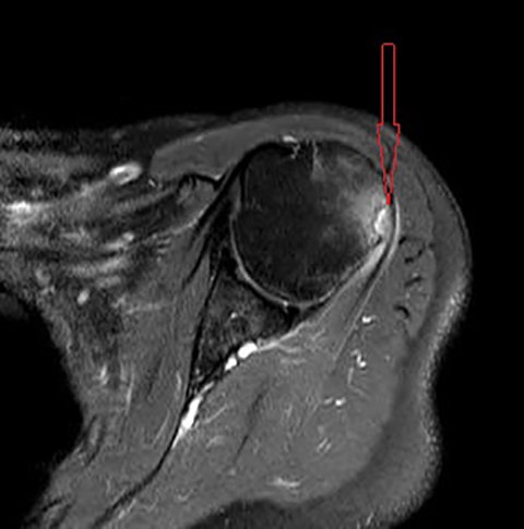 Applied_Rad's tweet photo. What's your diagnosis? A 55-year-old woman presented with a 3-month history of left shoulder pain occurring less than 24 hrs after receiving an influenza vaccination and a tetanus, diphtheria, and pertussis (Tdap) vaccination.  See full case details here: https://t.co/b675ip2QTd https://t.co/K1lCZDB9hW