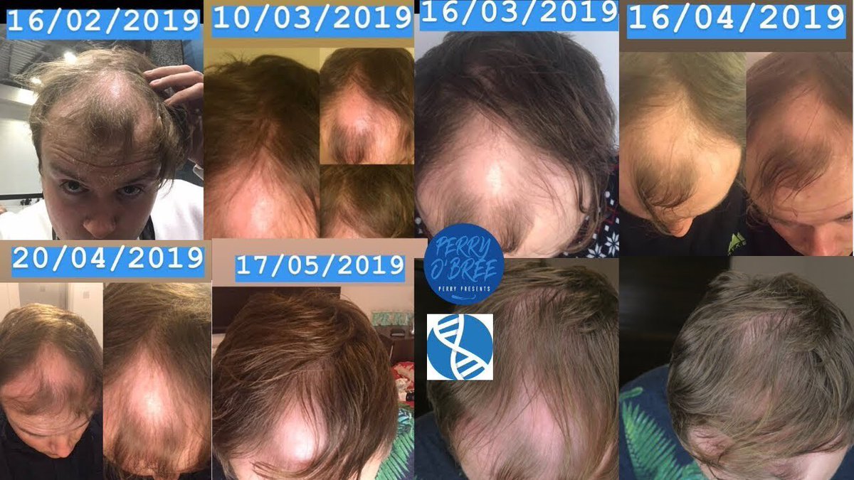 PerryPresents_'s tweet photo. NEW VIDEO: Hair Loss Update! I trialled @phl_uk hair loss products and here are the results: https://t.co/9rFQ7dH181 #PreventionHairLoss #Sponsored #HairLossHappens #PHLUK https://t.co/MoY75xp9HE