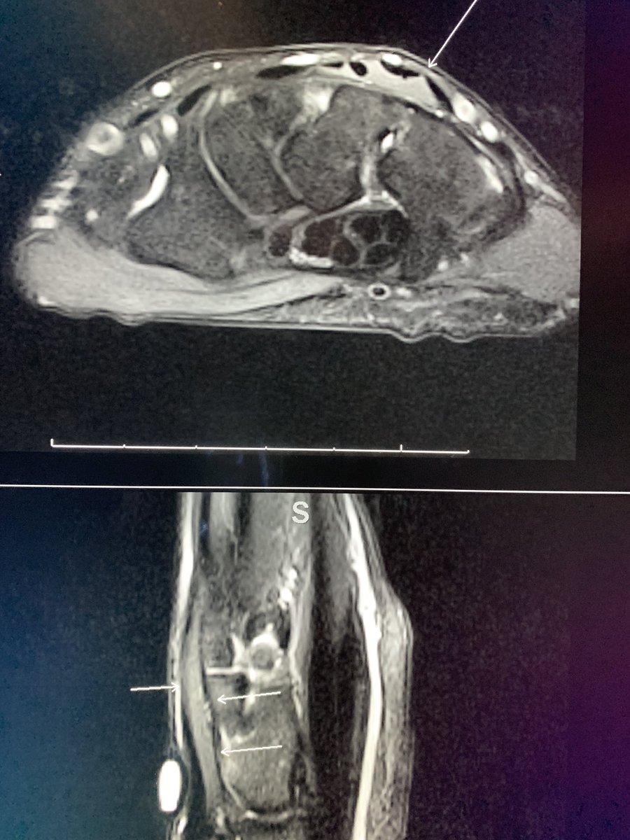 What’s causing dorsal wrist pain radiating all the way prox to the lateral epicondyle in this high school baseball player?  Yes, it’s the notorious accessory extensor digitorum brevis manus!