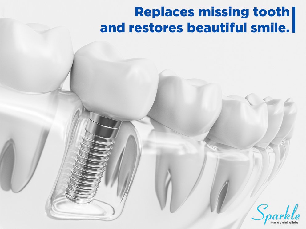 A #missingtooth leads to an incomplete smile that no one desires.      
#Dentalimplants are highly effective for #replacemissingteeth.
Visit the best #dentalclinic in #KalyaniNagar #Pune.
Visit: sparkledentalclinic.com
Call: 9730987134
#dentist #rootcanal #happysmile #dentalcare
