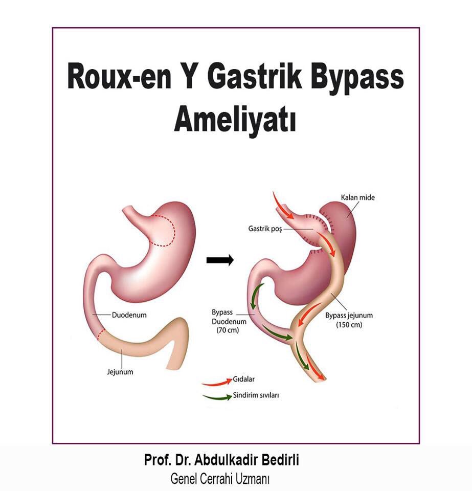 #obezite #şeker #diyabet #gastrikbaypass #tip2 #ankara #gaziüniversitesi #tüpmide #iletişim #duodenalswitch #revizyoncerrahisi #mideküçültme #diyet #sleveegastrektomi #vucutkitleindeksi #profdrabdulkadirbedirli #sekerameliyati #tip2diyabetcerrahisi