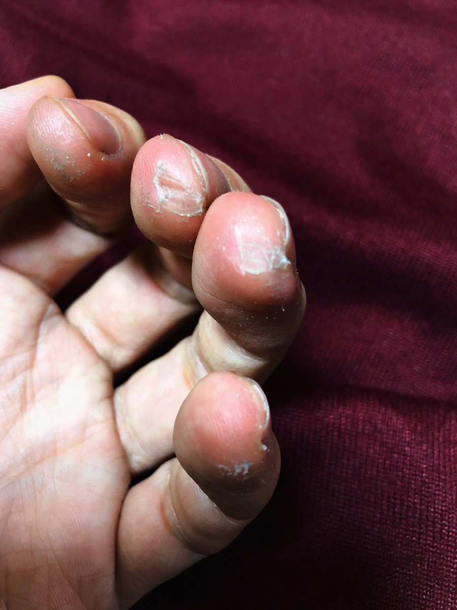 大村孝佳 ౪ ギタリストらしい指になってきました