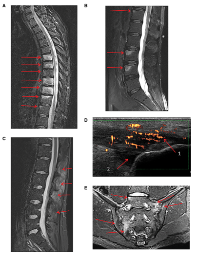 Emergence of severe spondyloarthropathy-related entheseal pathology following successful #vedolizumab therapy for inflammatory bowel disease ow.ly/xlBO50utuer