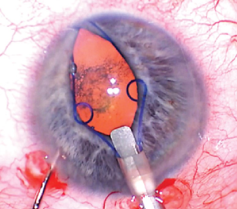 keelerusa's tweet photo. Are pharmacological pupil dilating devices more efficient than mechanical ones? Or is it the other way around? @EyeWorldMag has an explanation - tap the link to learn more!
https://t.co/e1Neuk0qzX
#Optometry #Ophthalmology #PupilDilation #OptometryNews https://t.co/KMMqE2bleL