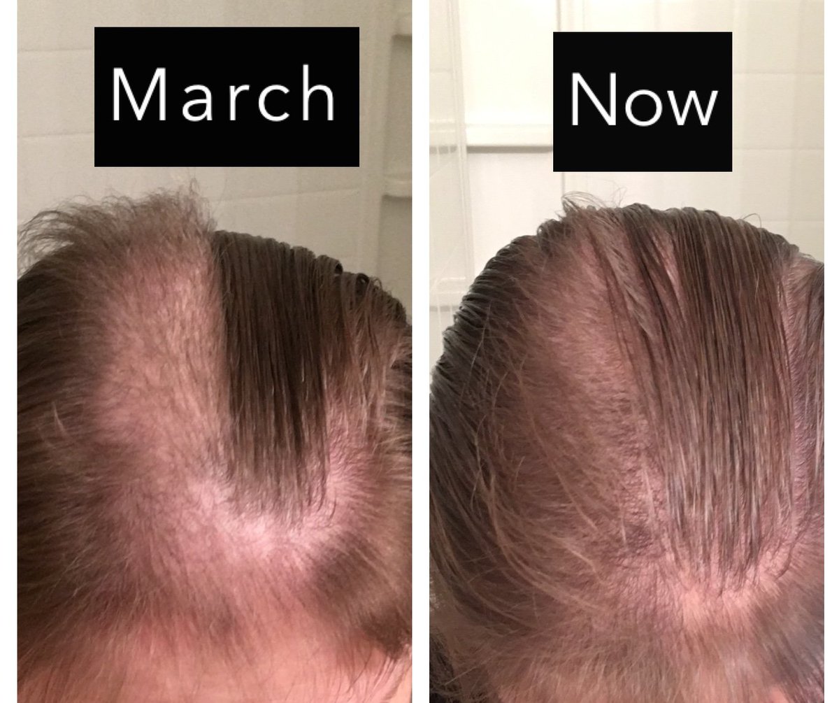 WarnJenn's tweet photo. Decided today was a great day to share, seeing as it's not only the last day of #MentalHealthAwarenessMonth, but also 2 months since the start of my longest #pullfree streak!
I have an OCD/anxiety disorder called #Trichotillomania.
(1/7) https://t.co/DFSXksAHPt