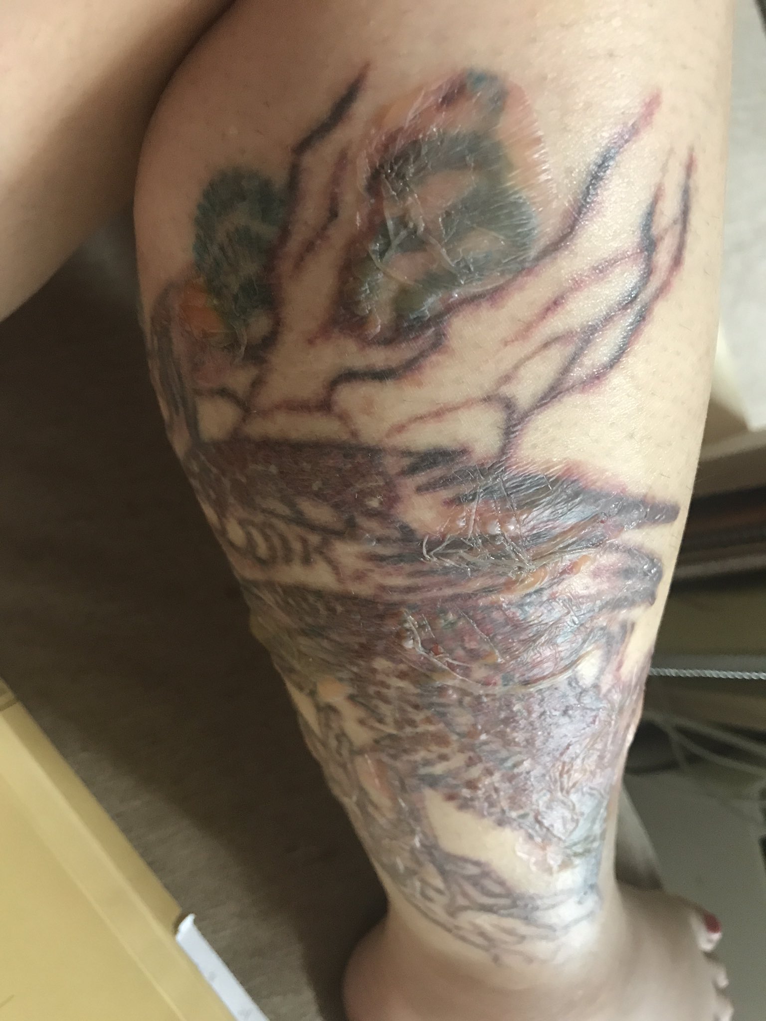 タトゥー消したいちゃん Clmkzsdtwknvnls Twitter