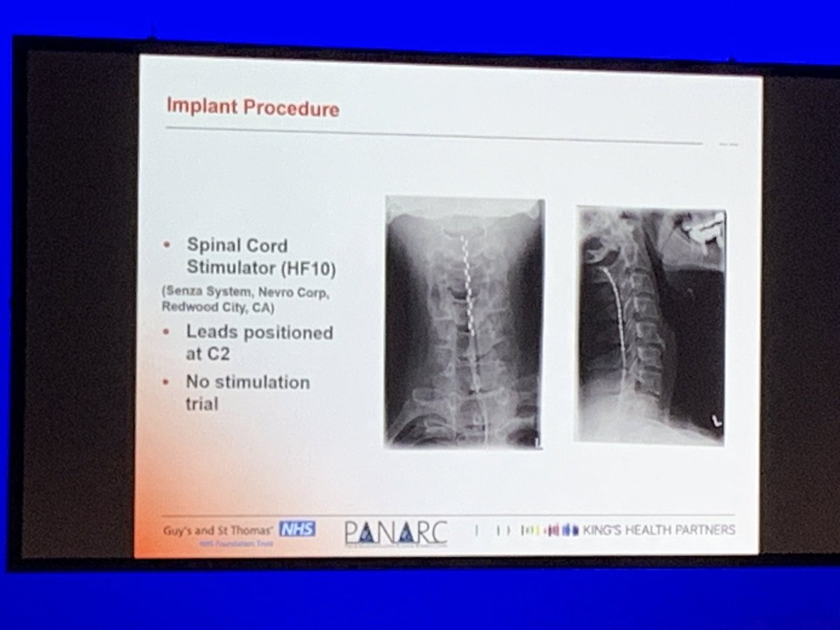 GeorgiosMatis's tweet photo. #migraine #SCS #neuromodulation #10kHz #HF @IntlNeuromod https://t.co/yq4g18SbmY
