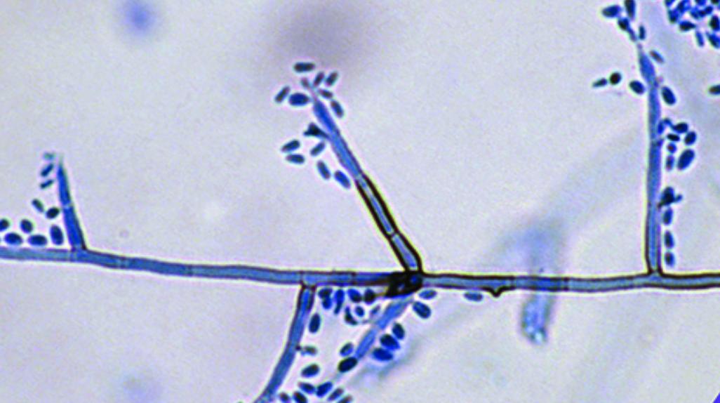 The Karius Test first detected Exophiala spinifera in 2017. This is an anamorphic #fungus found in soil and decaying wood. It is associated with #mycetoma and phaeohyphomycosis, and can infect both #immunocompromised and immunocompetent individuals.  #PathogenProfile #mcfDNA