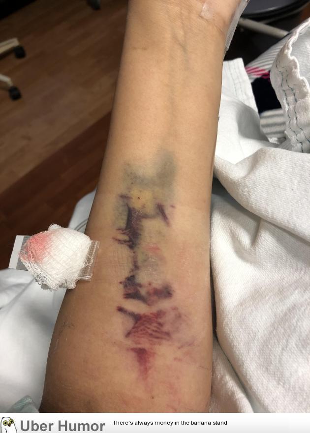 KimCaito's tweet photo. The bruises on my arm after nurses couldn’t find a vein https://t.co/UpTWVk8awq