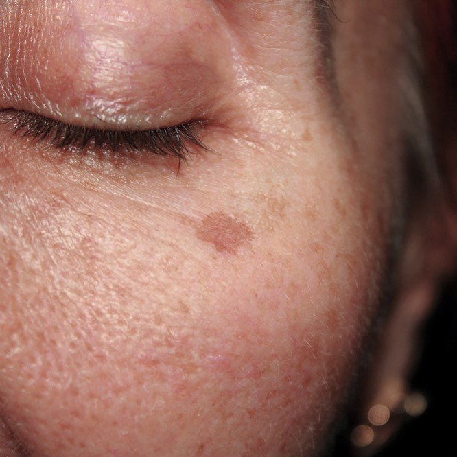 Are you worried that your age spots are telling people you're past your prime?  Our Endymed skin resurfacing treatment is a great choice to address age spots along with other concerns like fine lines and scars. Email us at bookings@revereclinics.com to find out more!