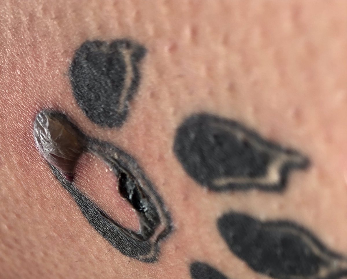 How Laser Hair Removal Affects Tattoos  Fresh Skin Canvas