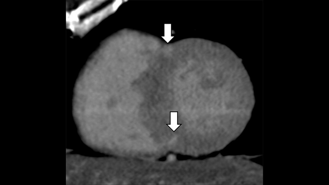 johananptm's tweet photo. Late enhancement imaging and extracellular volume analysis with dual-energy cardiac CT is an alternative to #MRI for assessing myocardial disease. https://t.co/3uxmpCn8vU #CVRad #CTRad https://t.co/3LjH63ZcRA