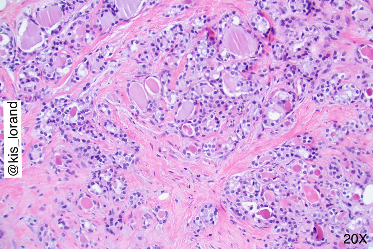 kis_lorand's tweet photo. Breast biopsy with the following histology. Classical 3 questions 😀
1. What is the phenotype of the cells?
2. What is your understanding about the GATA3 expression of the cells?
3. If you see the same lesion in cervical biopsy what would you call it?
#pathology #breastpath https://t.co/DKN42udLi5