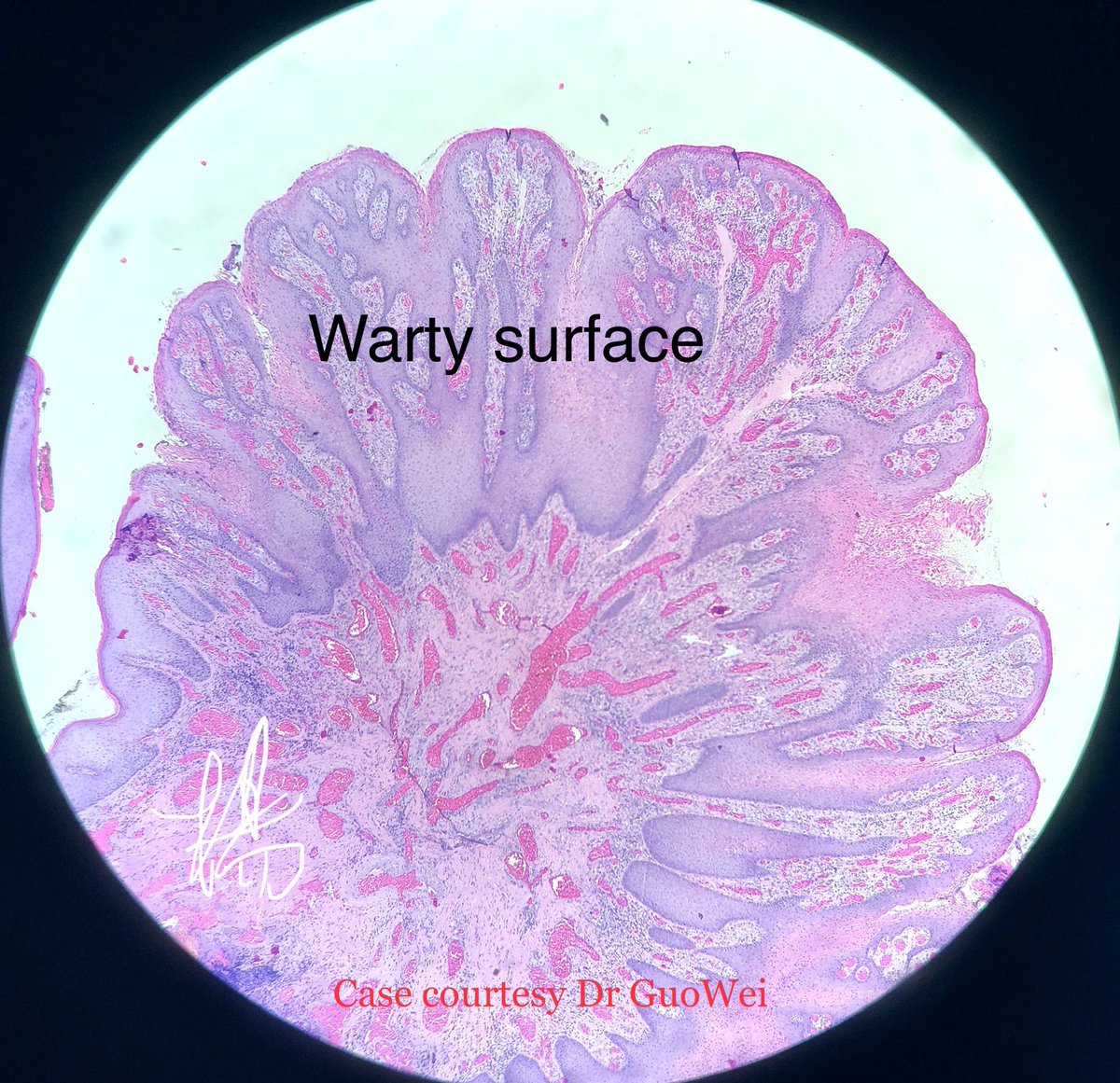 HENRYY_MD's tweet photo. You may just want to call it a “wart” or “ squamous papilloma “ in genital or oral areas and let go, No, it is verruciform xanthoma (疣状黄瘤）1) oral or genital location 2) warty like surface. 3) bright pink parakeratosis with neuts 4) foamy cells in papillary dermis.#Dermpath https://t.co/lrZ0I32hI7