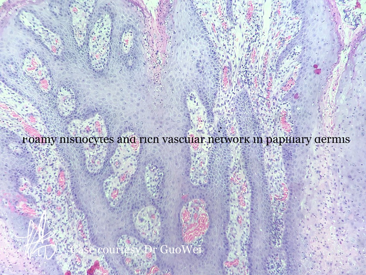 HENRYY_MD's tweet photo. You may just want to call it a “wart” or “ squamous papilloma “ in genital or oral areas and let go, No, it is verruciform xanthoma (疣状黄瘤）1) oral or genital location 2) warty like surface. 3) bright pink parakeratosis with neuts 4) foamy cells in papillary dermis.#Dermpath https://t.co/lrZ0I32hI7