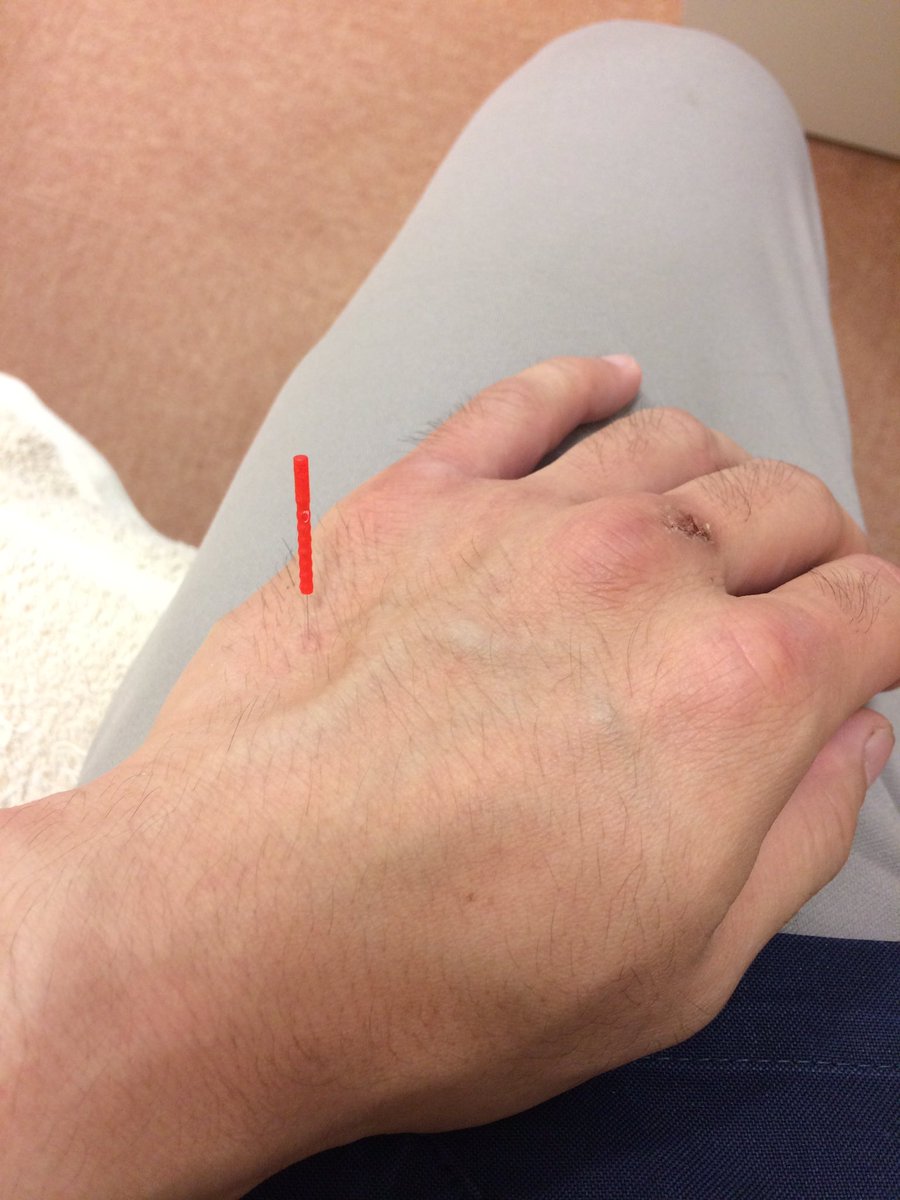 sin81291190's tweet photo. 最近、下半身トレーニングに力を入れた結果はお尻が痛くなり体重移動がスムーズにできない。

そんな時は鍼の出番！

手の鍼でお尻の痛み緩和。

今日も練習で追い込みます。

#整動鍼 #トレーニング #お尻の痛みのツボ https://t.co/z9xdYHEhg4