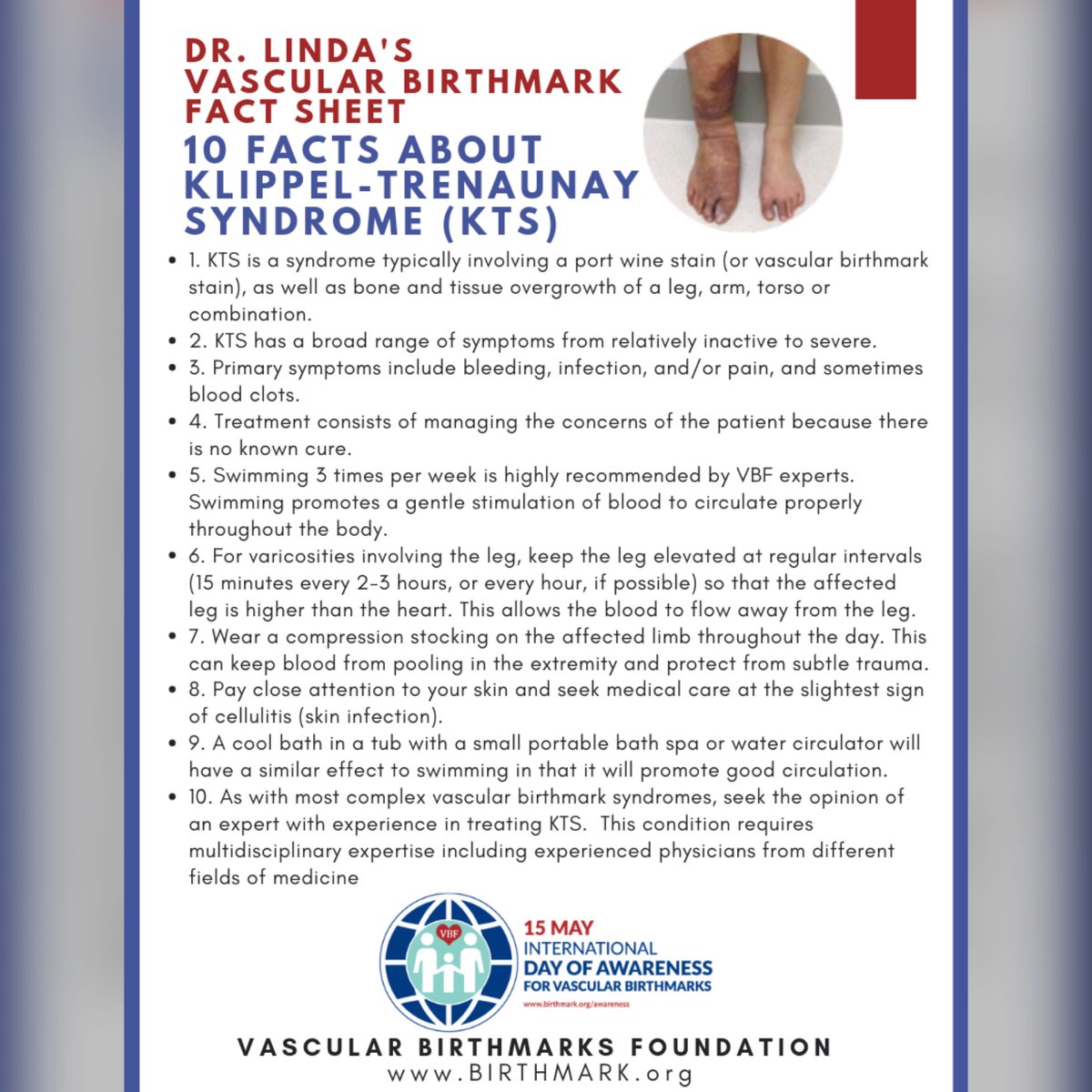 Presenting: Dr. Linda’s Vascular Birthmark Fact Sheets for VBF’s Month of Awareness for Vascular Birthmarks!
Here are the TOP 10 FACTS for KTS! SHARE to raise awareness in every corner of the world this May.

Fact Sheets here:  birthmark.org/factsheets/
