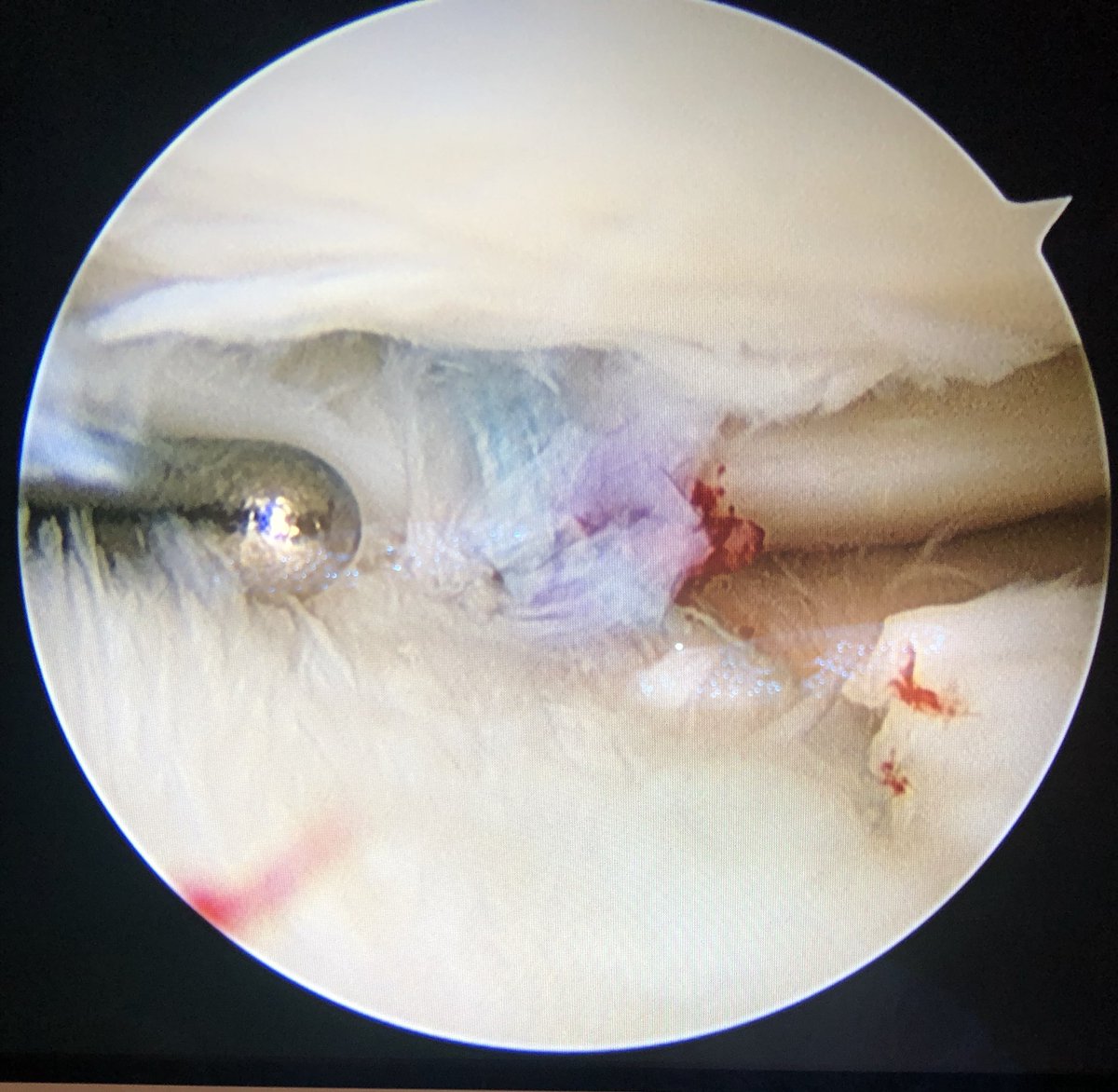 stablekneez's tweet photo. The menisci of the knee are not simply shock absorbers. They have several functions. Learn more about this, their injury, and their repair in this new blog post by @mickwhughes here:  LINK ⬇️⬇️⬇️

https://t.co/b6abw7mAgM https://t.co/Pca2azh3Gl