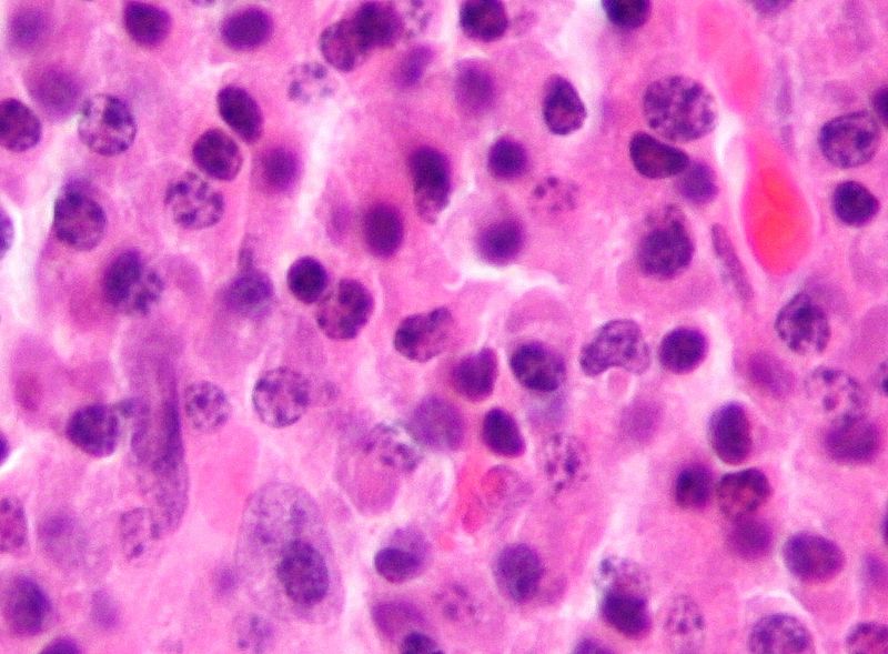 USI University (@usi_university) on Twitter photo Our Prof <a href="/frbertoni/">Francesco Bertoni</a> has recently added information on our knowledge of two hematological malignancies: MALT Lymphoma and Peripheral T-cell lymphoma. The results have been published <a href="/Haematologica/">Haematologica</a> & <a href="/ModernPathology/">Modern Pathology</a>:
ior.iosi.ch/site/?p=1847 (Image Nephron, Wiki) Our Prof <a href="/frbertoni/">Francesco Bertoni</a> has recently added information on our knowledge of two hematological malignancies: MALT Lymphoma and Peripheral T-cell lymphoma. The results have been published <a href="/Haematologica/">Haematologica</a> & <a href="/ModernPathology/">Modern Pathology</a>:
ior.iosi.ch/site/?p=1847 (Image Nephron, Wiki)