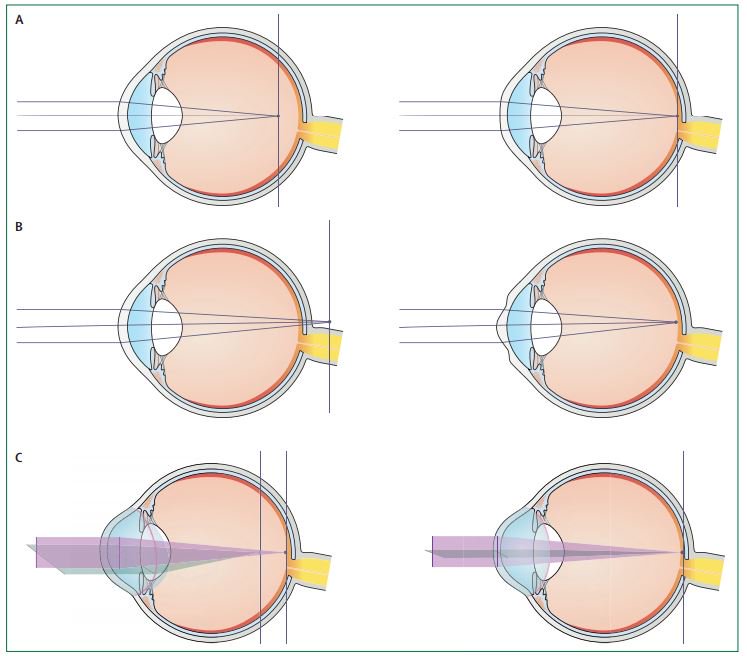 Mi a presbyopia? | CooperVision