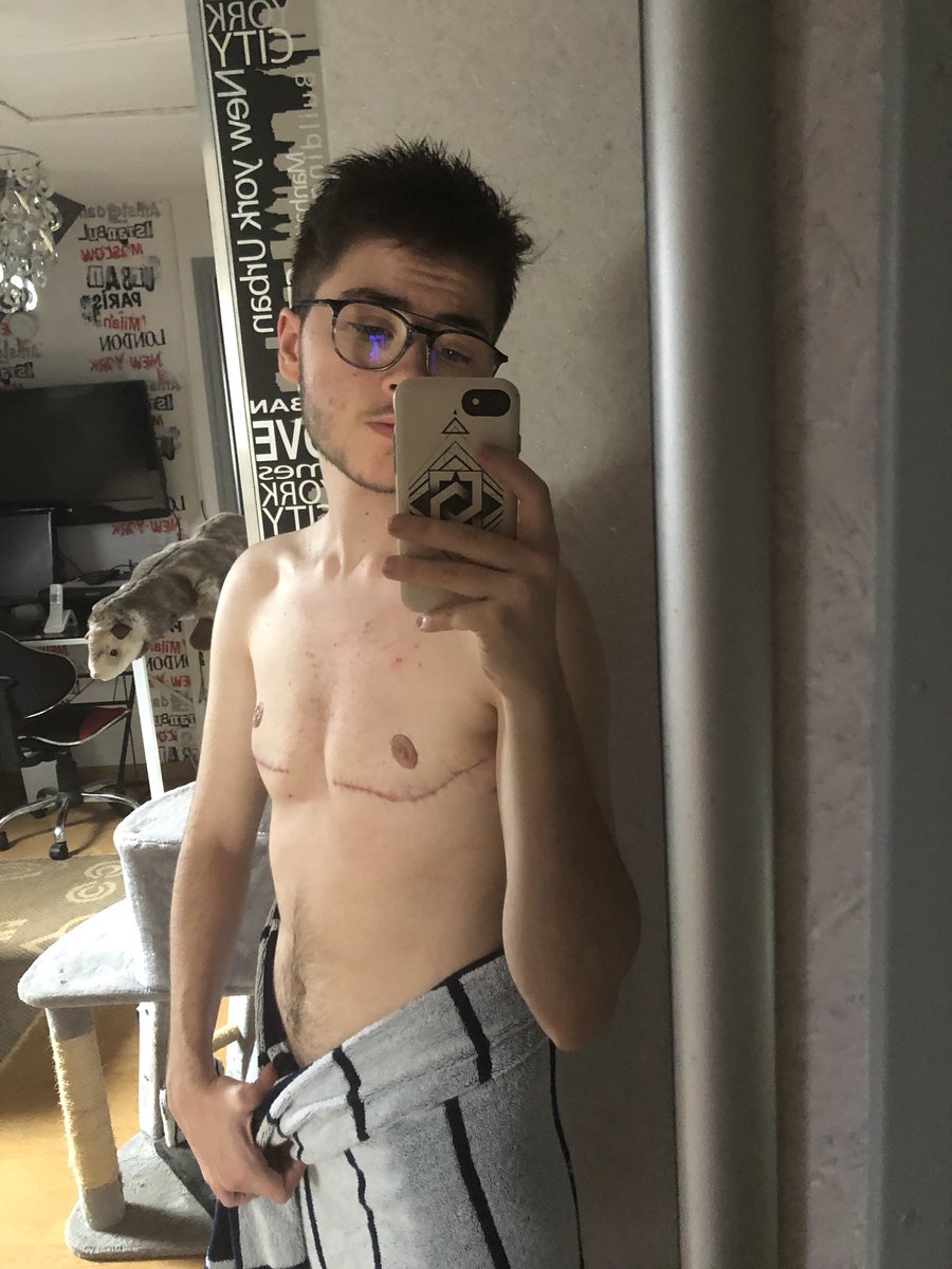 scars 2 months post-op  (don’t mind the cream on my chest on the 1st picture, c’était juste avant de prendre ma douche)