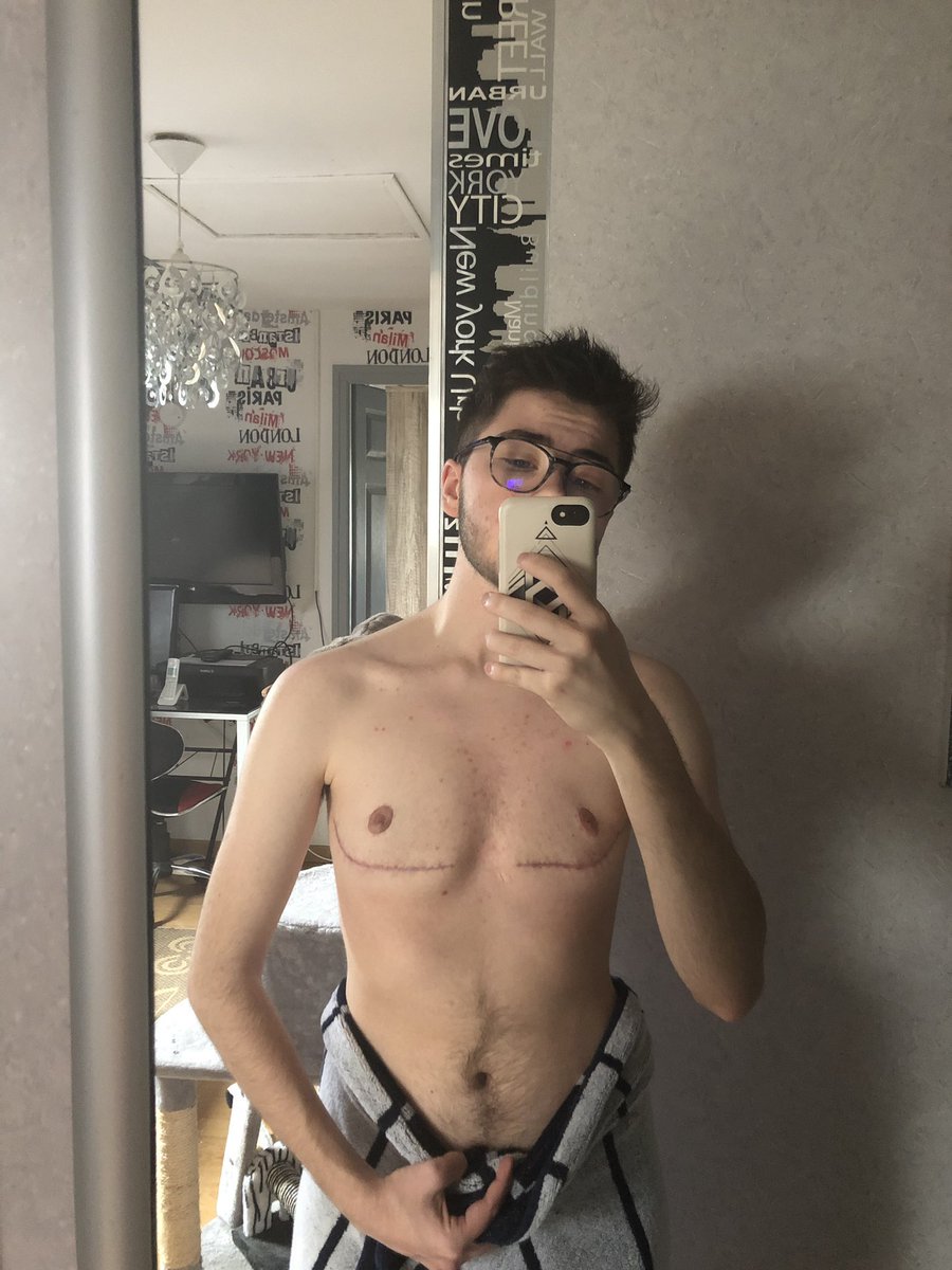 scars 2 months post-op  (don’t mind the cream on my chest on the 1st picture, c’était juste avant de prendre ma douche)