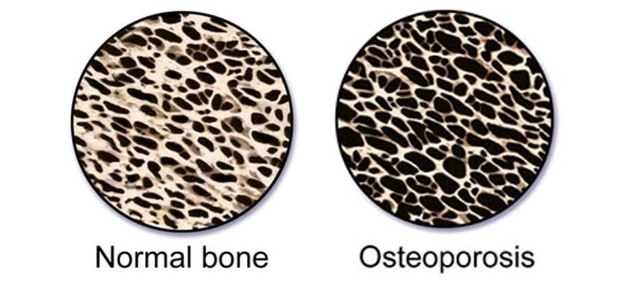 Did you know: One in two women and up to one in four men over the age of 50 will break a bone due to osteoporosis? Write your legislators and encourage them to co-sponsor HR 2693/S 283: buff.ly/2LGrYSn