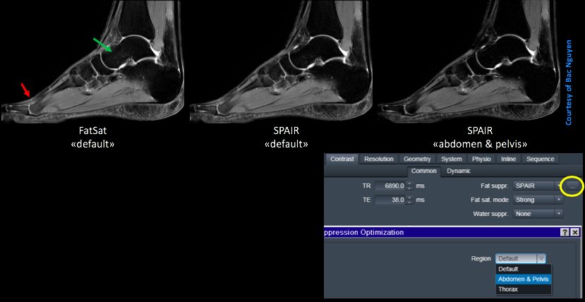 s_magneticworld's tweet photo. MR Fat Suppression optimising @ Siemens 3T Skyra. For more information please visit our Instagram group 👇
https://t.co/wZb1UC3jdQ
#smagnetic #siemens #MRI #footankle #Skyra #threeTesla https://t.co/uExlWbkIQu