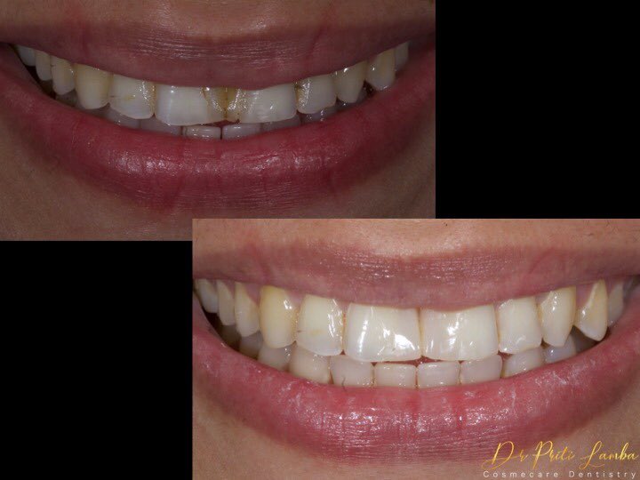 priti_lamba's tweet photo. Because this pretty lady deserved a beautiful smile👍🏻 !Replacing old composites for space closure in a single sitting..Book an appointment at 02225200913/ 8779689297
https://t.co/hKFJLk015V #cosmecaredentistry #compositeveneers #smilemakeover #zoombleaching #dentalimplants https://t.co/39HkVDsWoc