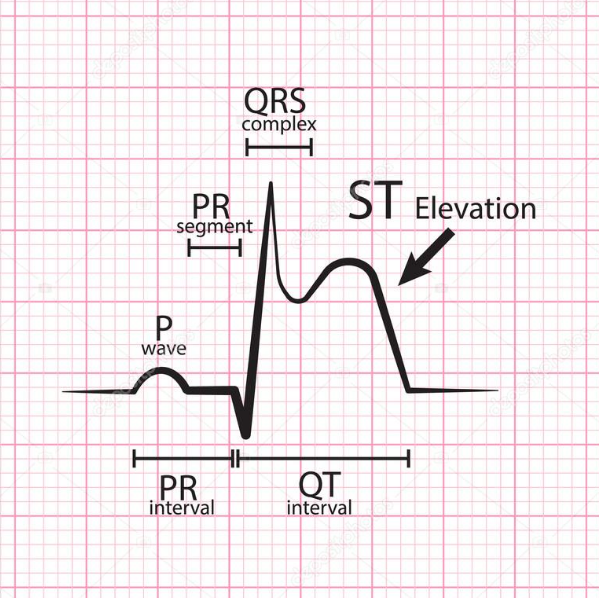 eldoc24's tweet photo. En ausencia de BRI o hipertrofia ventricular izq, es diagnóstico de IAMCEST la elevación de ST en punto J en al menos 2 derivaciones contiguas, ≥2 mm en hombres o ≥1,5 mm en mujeres en V2-V3 y/o ≥1 mm en otras derivaciones precordiales contiguas o derivaciones periféricas. https://t.co/X9w12R6CKw