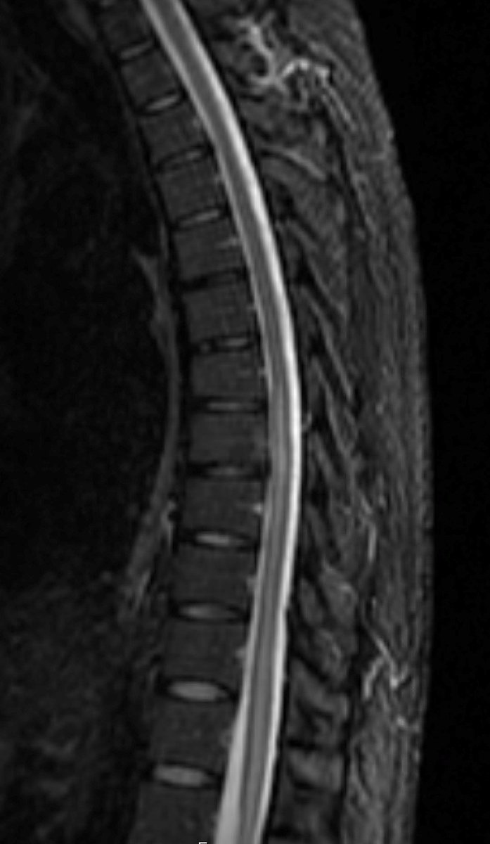 TheASNR's tweet image. What could this be? Look at the history and images for this #SpineImaging #ASNR19 Case of the Day by Drs. @JAcharya4 , Anandh Rajamohan, and @jlgomd in Exhibition Hall C. Submit your answer for a chance to win! #Neuroradiology #COTD Please don&apos;t give away the answer if you know!