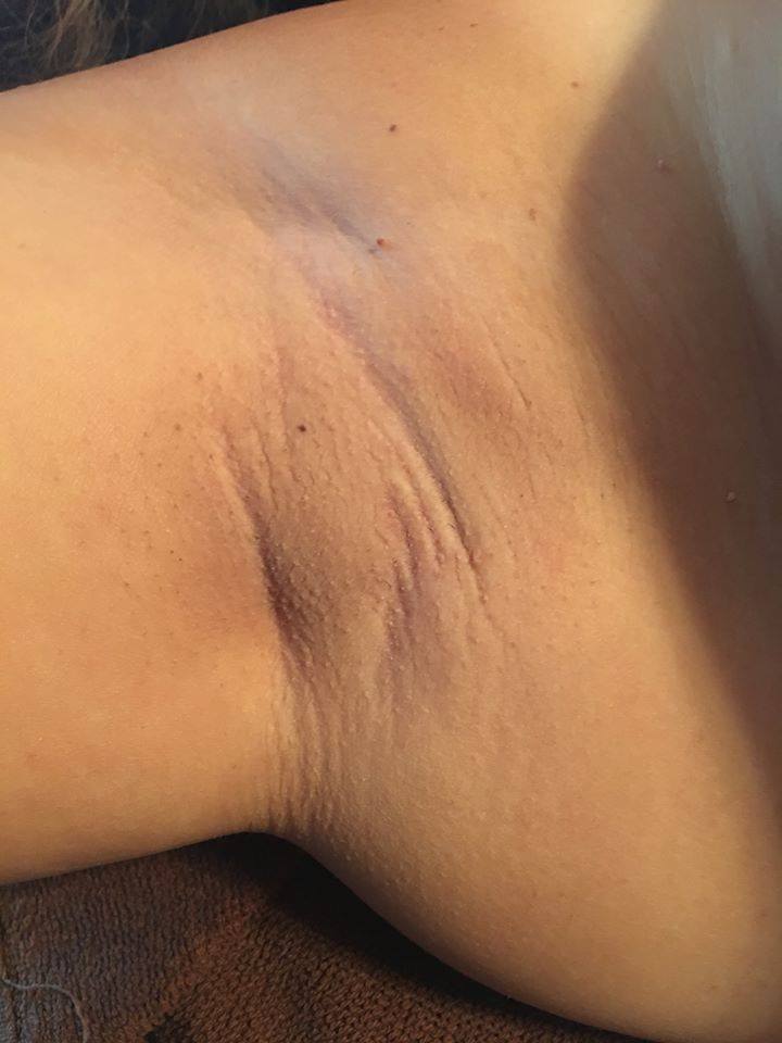 Sick of waxing and shaving? Purchase a Laser Hair Removal package and get your skin ready for summer! 
dermalasercenterny.com