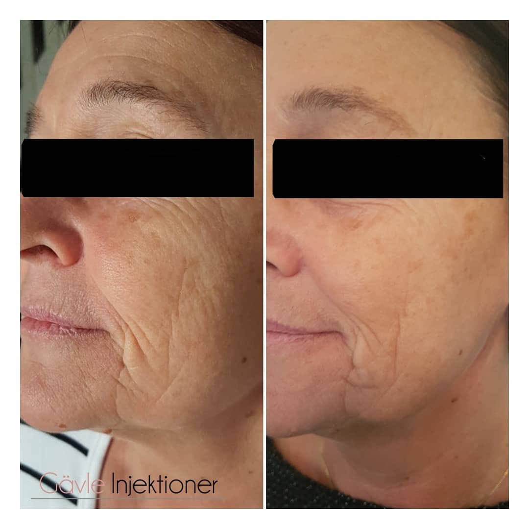 Twitter 上的 Profhilo："gavle_injektioner Profhilo bioremodelling collagen elastin