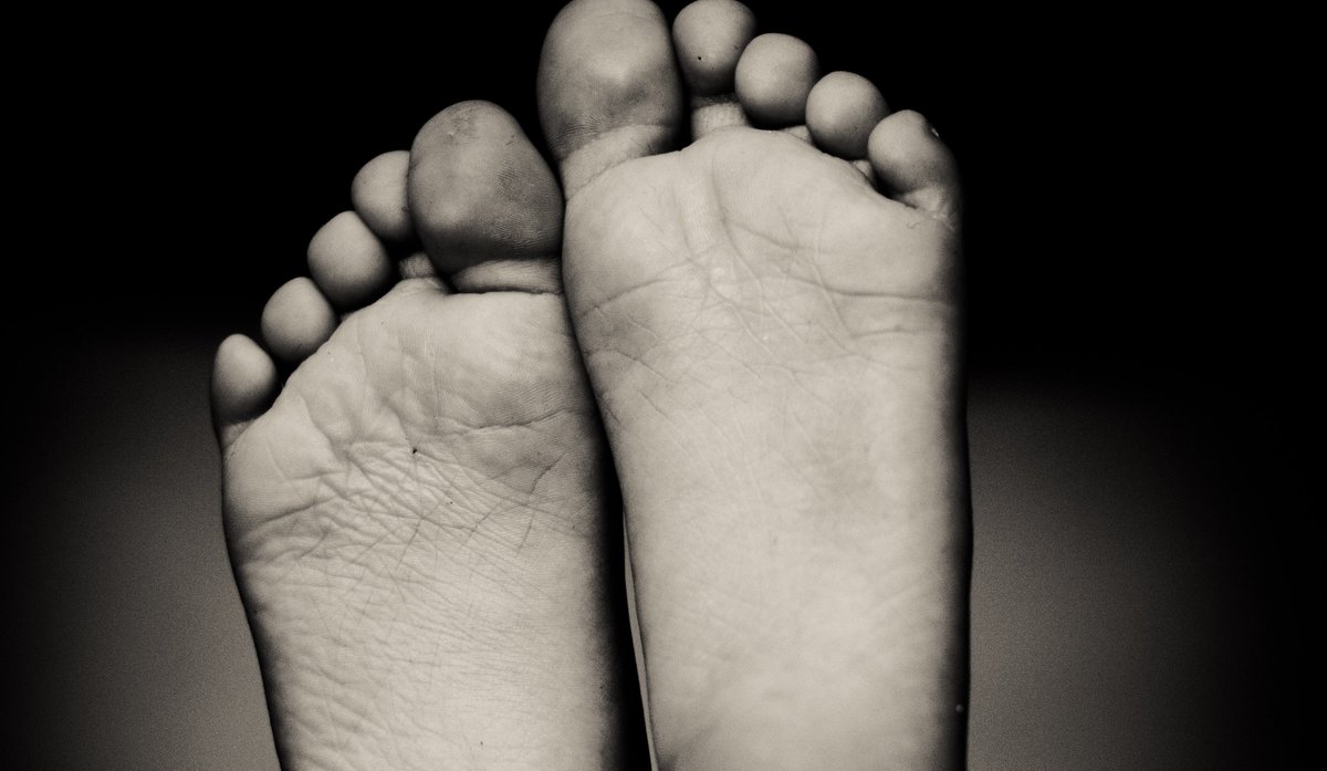 <a href="/OrthoCarolina/">OrthoCarolina</a> <a href="/Xbox/">Xbox</a> <a href="/UofDenver/">University of Denver</a> Now, <a href="/AnkleInstitute/">OrthoCarolina Foot & Ankle Institute</a> clinical trials- Total ankle arthroplasty is a major surgery that doctors- at 1 time- discouraged patients from having. Today, still major procedure, but patients are finding their lives have significantly improved thanks to total ankle replacements. (1/2)