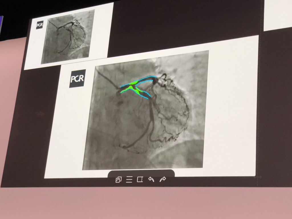 mirvatalasnag's tweet image. @GoranEBC defines view and anatomy #SyntaxScore Medina 1,1,1