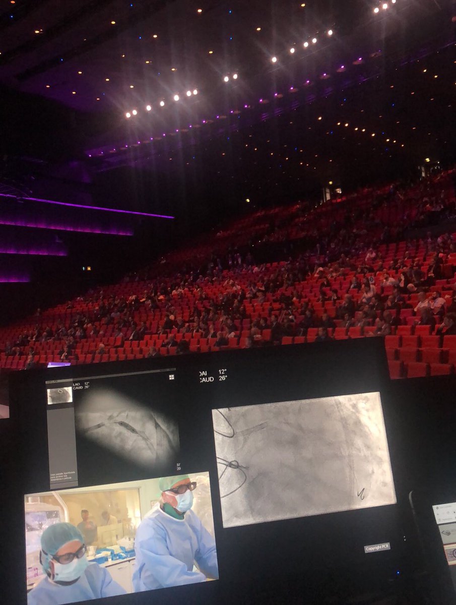 giampieroviz's tweet image. Terrific live Rota-Shock case performed by @JEscaned at #EuroPCR 2019!
@PCRonline 
#rotablator #shockwave #rotashock