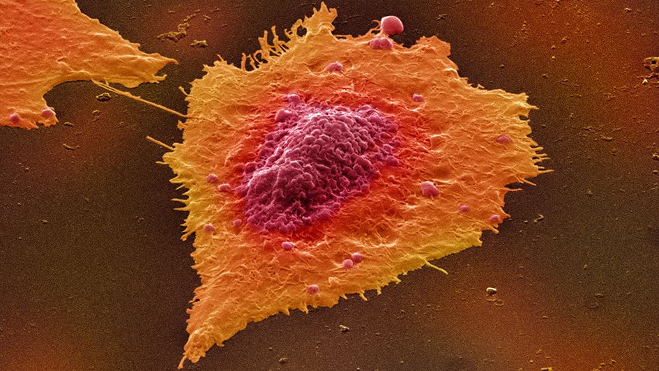 ICR_London's tweet photo. NEWS: A new test can genetically ‘barcode’ #BowelCancer and separate it into five different diseases that could each receive tailored treatment, a new study reports https://t.co/Ugv5FPZA3g https://t.co/psLh5YTzqS