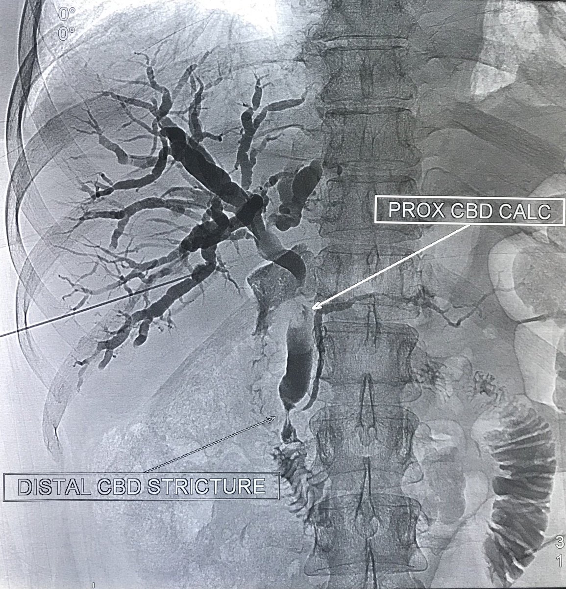 nikfarhan's tweet photo. Obstructive jaundice in a patient with ovarian malignancy. Diatal CBD stricture likely a malignant obstruction. #PTBD #irad #IRad #Withoutascalpel #intervensi #PPUKM #InterventionalRadiology https://t.co/sCInT7Lsmm