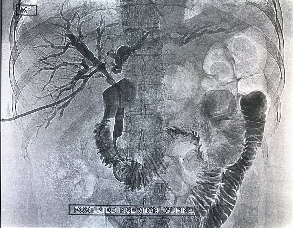 nikfarhan's tweet photo. Obstructive jaundice in a patient with ovarian malignancy. Diatal CBD stricture likely a malignant obstruction. #PTBD #irad #IRad #Withoutascalpel #intervensi #PPUKM #InterventionalRadiology https://t.co/sCInT7Lsmm