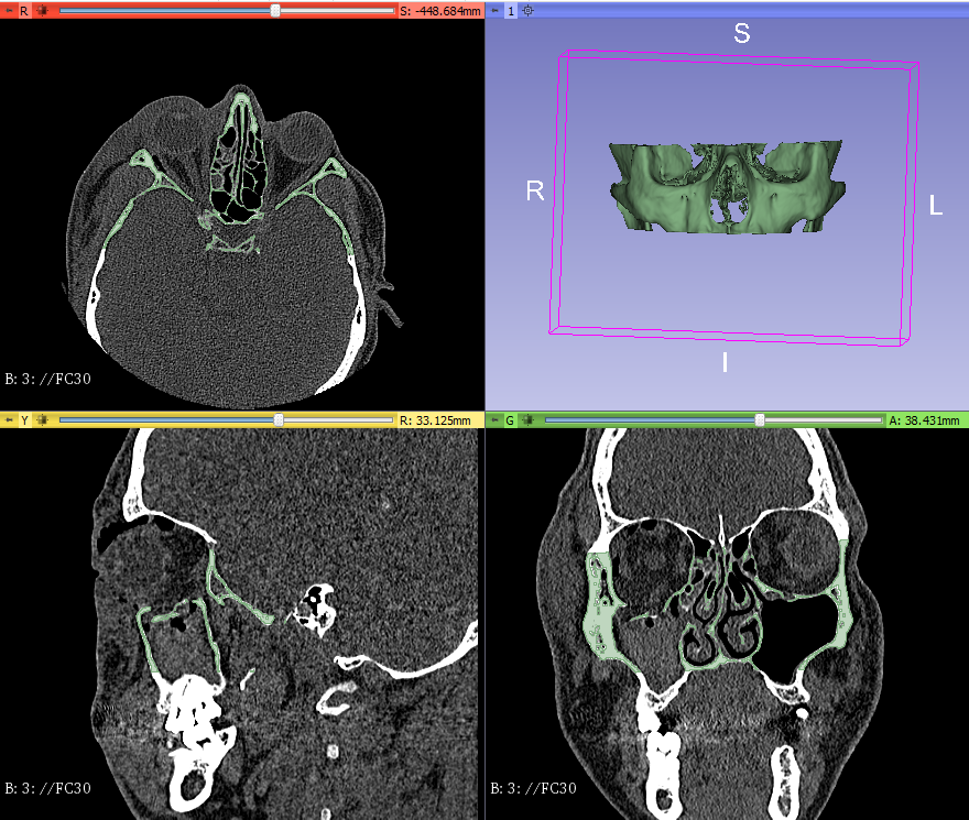 3d_maranon's tweet photo. 3D resin model to be used as template to pre-form the plate of the patient that suffered a fracture in the right orbital floor. This model is a mirror of the healthy side of the patient. #HospitalMarañon3D FabLab team: @rupermac @calvoharo_ja @diegotrap @kn_ord https://t.co/7xRe7WHEQf