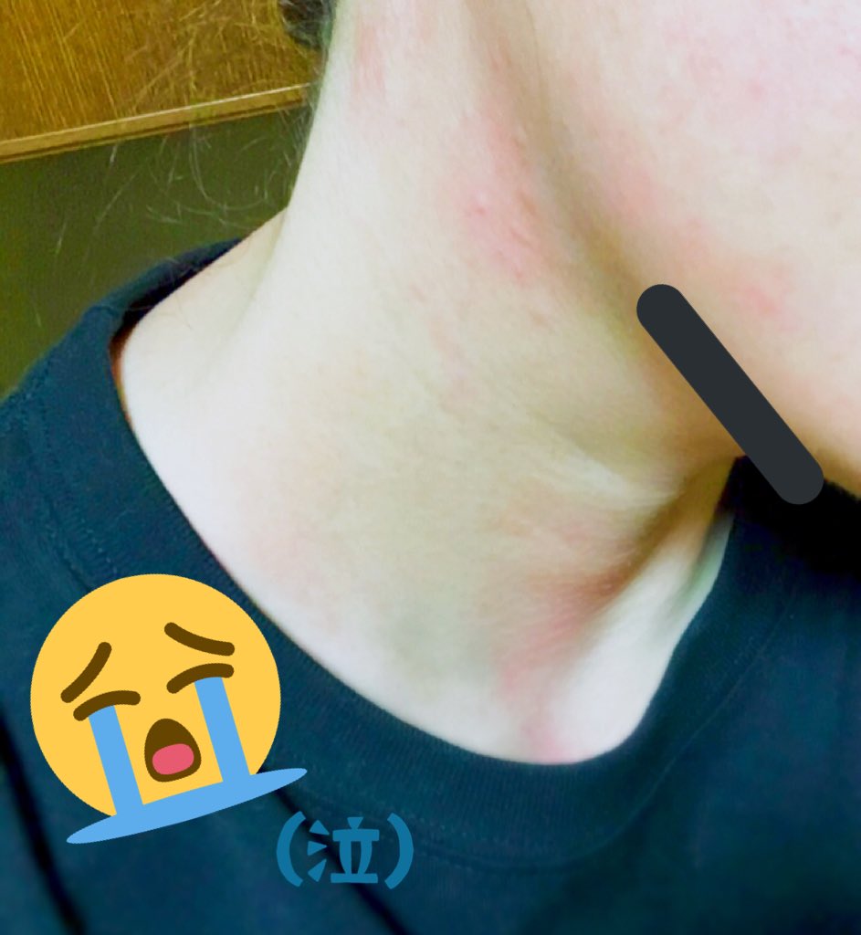 るる お風呂上がりはいつもこうなる 反対側はもっとブツブツ出てるんだけど あまりにも気持ち悪いので自粛www あーー 痒い痒い痒いヾ Gt Lt ﾉﾞ T Co Kbmkabsuu8 Twitter