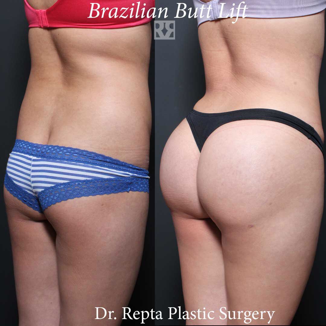 Dr. Remus Repta on X: BBL - Brazilian Butt Lift! 🍑 During a BBL