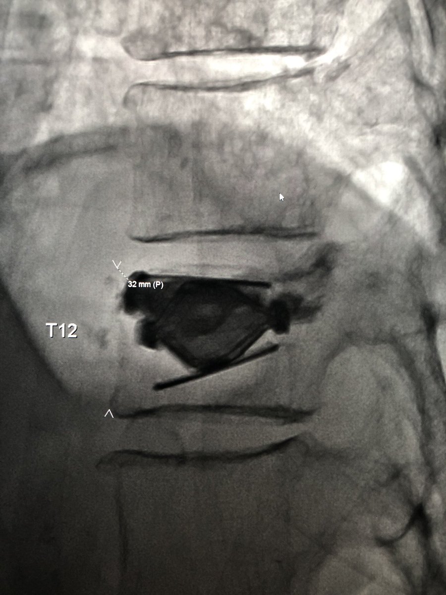 Arun Jagannathan (@dr_ajag) on Twitter photo Loving this #spinejack, 10mm height #restored at T12. #antikyphosis #irad <a href="/_backtable/">BackTable Vascular and Interventional</a> <a href="/SIRspecialists/">Society of Interventional Radiology</a> <a href="/IRadLab/">IRad Lab</a> Loving this #spinejack, 10mm height #restored at T12. #antikyphosis #irad <a href="/_backtable/">BackTable Vascular and Interventional</a> <a href="/SIRspecialists/">Society of Interventional Radiology</a> <a href="/IRadLab/">IRad Lab</a>