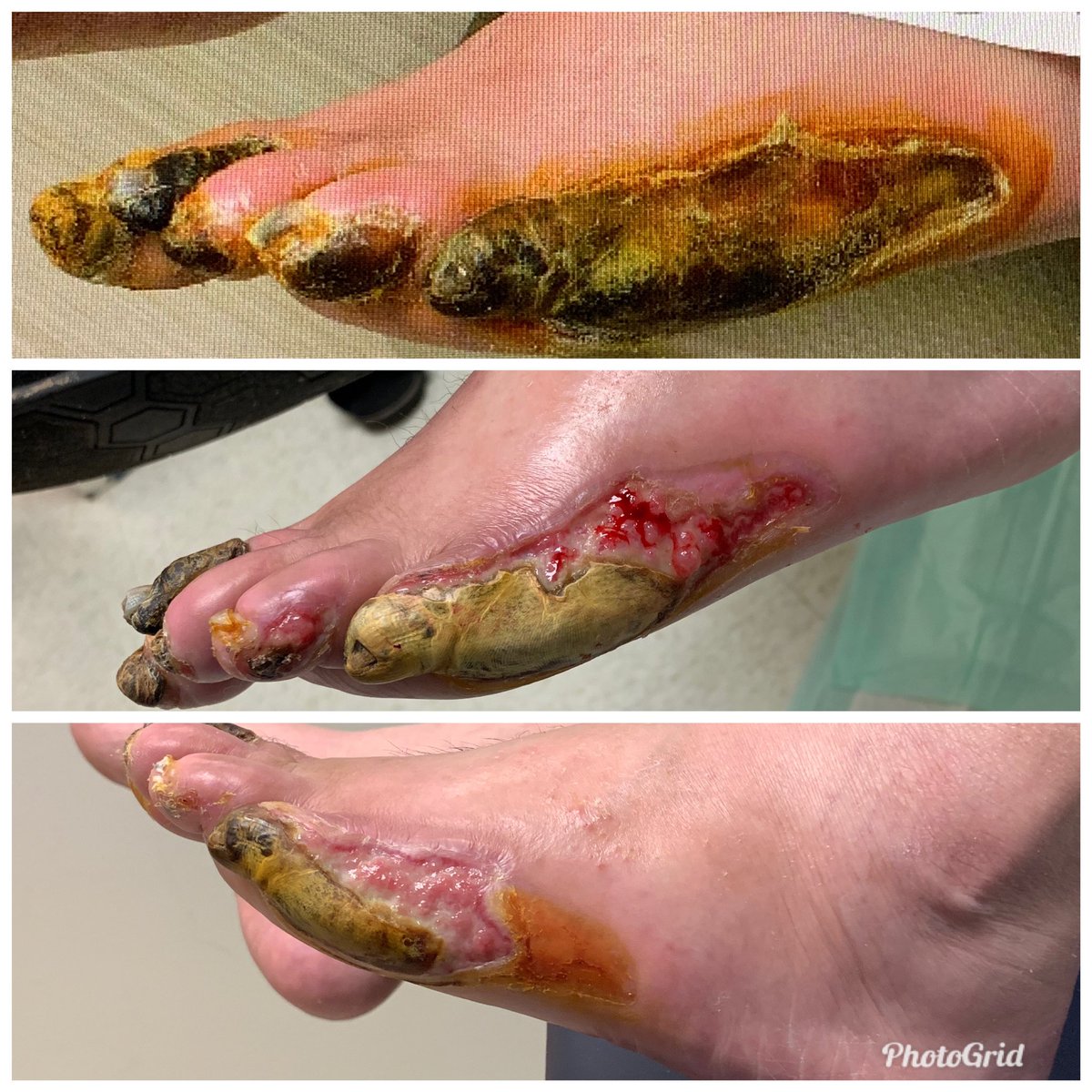 Why do #CLIFighters do what we do? Antegrade/retrograde pop, pero, and PT recan with excellent supply to DP. Baseline, 2 week, 4 week pics. Now getting 2 toe amps instead of BKA. Life changing! <a href="/AMI_Vascular/">Vascular Institute of Atlantic Medical Imaging</a> @MdPetruzzi @AMIRadiology <a href="/CLI_Global/">CLI Global Society</a> <a href="/AMPSymposium/">AMP the CLTI Meeting</a> <a href="/kmadass/">Kumar Madassery</a> <a href="/SDhandMD/">Sabeen Dhand</a>