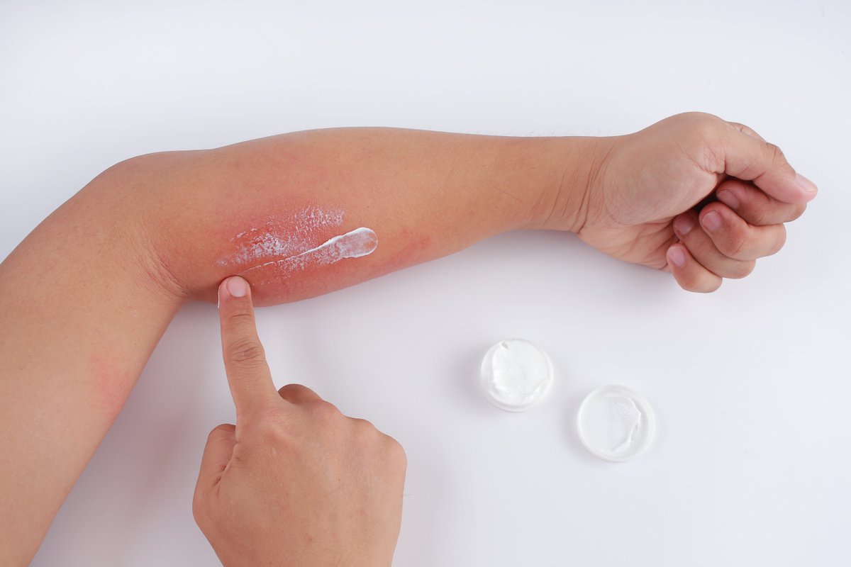 Allergic reactions triggered by the skin touching something are very common. This type of allergy is called contact allergy or ‘contact dermatitis’. Visit our new patient website for more information: skinhealthinfo.org.uk/symptoms-treat… @allergyuk