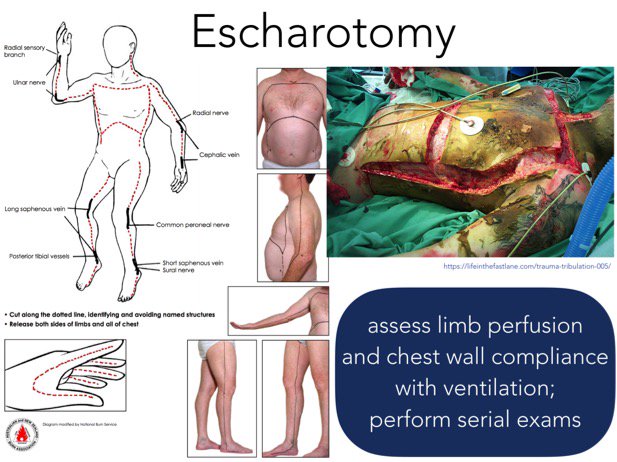 EMCases's tweet photo. Burn &amp; Inhalation Injuries: ED Wound Care, Resuscitation &amp; Airway Management with Joel Fish &amp; Maria Invankovic.

Special segment on awake intubation with @kovacsgj

Rule of 9's is dead. Same with Parkland. Same with daily dressings...
https://t.co/sVrwJnmGev
#FOAMed https://t.co/MZFpsv5uqn
