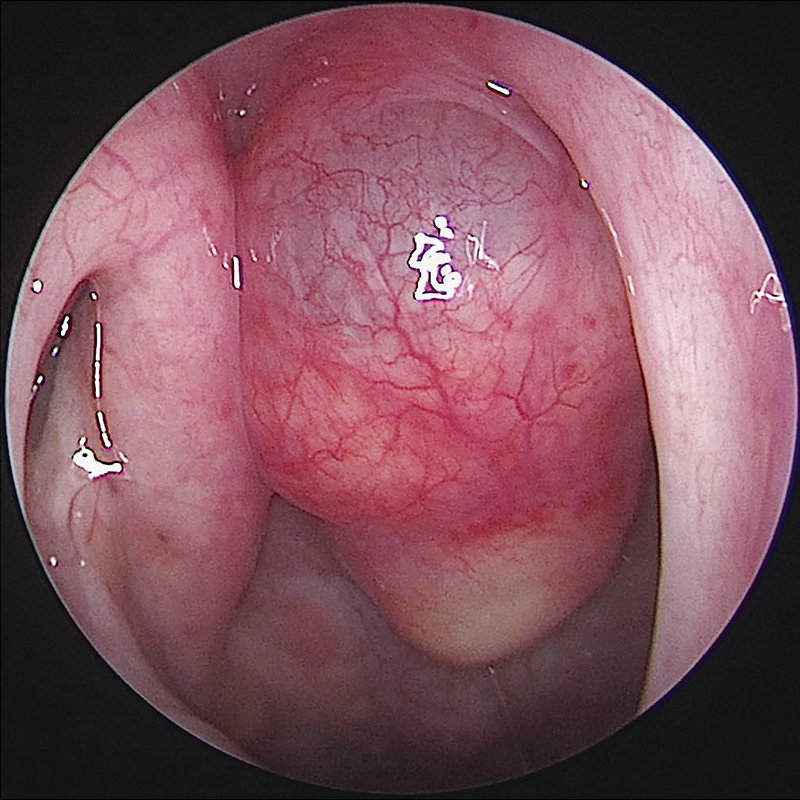 NEJM в Твиттере: "Image of the Week: Tornwaldt’s Cyst https: