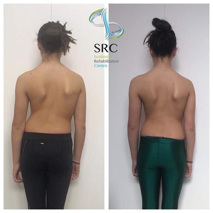 ScolioCentar's tweet image. Nakon dva meseca intezivnog rada može se videti fantastičan rezultat. Radjene su ISST Schroth vezbe dva puta dnevno u trajanju od 1,5 sat i svakodnevno je nošen mider! Slika sve govori!😊💪🏻

#scoliosis #schrothmethod #scoliocentar #isstschroth #scoliosisexercises